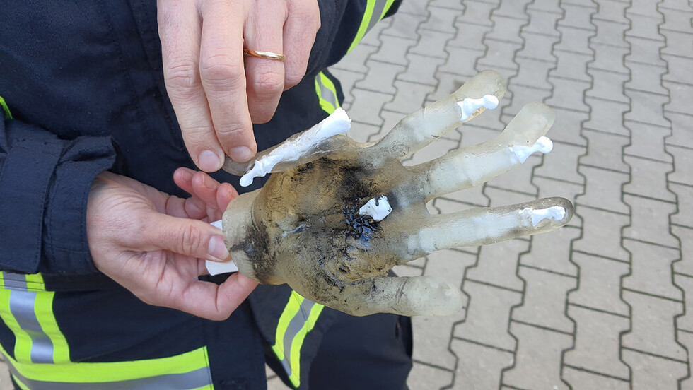Schwere Verletzungen nach der Explosion eines illegalen Böllers an einer Dummie-Hand.